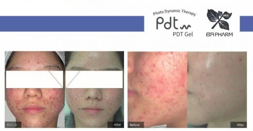 PDT photodynamic therapy acne treatment before & after picture